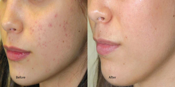 skin peel for acne